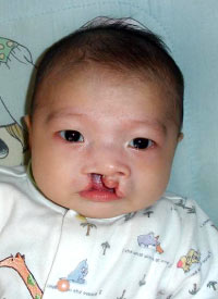 Zhao Jing Ping before the surgery