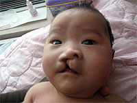 5 children will be able to receive cleft lip/palate surgeries