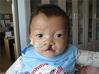 5 children will be able to receive cleft lip/palate surgeries