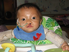 Hu Jian Lu before his cleft lip surgery