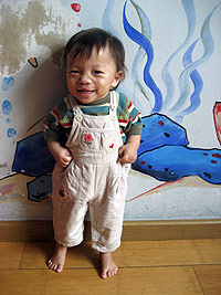 Hu Jian Lu after the cleft lip surgery