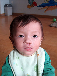 Hu Jian Lu after the cleft lip surgery